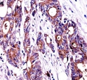 NPM1 antibody immunohistochemistry analysis in formalin fixed and paraffin embedded human colon carcinoma.