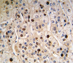 IHC analysis of FFPE human hepatocarcinoma tissue stained with anti-PCNA antibody
