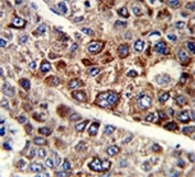 IHC analysis of FFPE human hepatocarcinoma with CD38 antibody