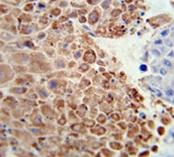PHGDH antibody immunohistochemistry analysis in formalin fixed and paraffin embedded human hepatocarcinoma.