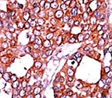 IHC analysis of FFPE human breast carcinoma tissue stained with the CDC25A antibody.