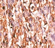 IHC analysis of FFPE human hepatocarcinoma tissue stained with the phospho-KDR antibody.