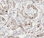 IHC staining of FFPE human breast cancer with phospho-Histone H3 antibody. HIER: boil tissue sections in pH 9 10mM Tris with 1mM EDTA for 20 min and allow to cool before testing.