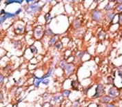 IHC analysis of FFPE human hepatocarcinoma tissue stained with the phospho-ERBB4 antibody.