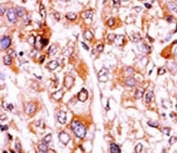 IHC analysis of FFPE human hepatocarcinoma tissue stained with the phosphorylated-p21 antibody.