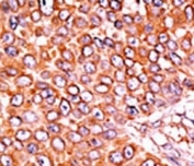 IHC analysis of FFPE human breast carcinoma tissue stained with the phospho-p27Kip1 antibody.