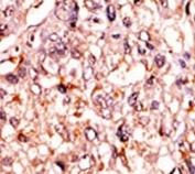IHC analysis of FFPE human hepatocarcinoma tissue stained with the phospho-p53 antibody