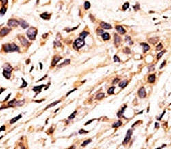IHC analysis of FFPE human breast carcinoma tissue stained with the phospho-Rb antibody.