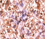 IHC analysis of FFPE human hepatocarcinoma tissue stained with the phospho-Rb antibody.