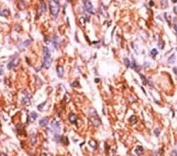 IHC analysis of FFPE human hepatocarcinoma tissue stained with the p-Rb1 antibody.