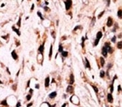 IHC analysis of FFPE breast carcinoma stained with phospho-SMAD4 antibody.