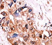 IHC analysis of FFPE human hepatocarcinoma tissue stained with the phospho-Src antibody.
