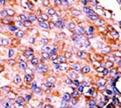 IHC analysis of FFPE human breast carcinoma tissue stained with the p-STAT3 antibody.
