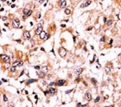 IHC analysis of FFPE human hepatocarcinoma tissue stained with the phospho-Wee1 antibody.