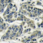 IHC analysis of FFPE human breast carcinoma stained with S6K antibody