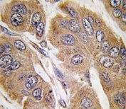 IHC analysis of FFPE human breast carcinoma tissue stained with p70S6K antibody