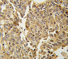 HIF1 alpha antibody IHC analysis in formalin fixed and paraffin embedded lung carcinoma.