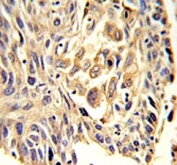 ZO-1 antibody IHC analysis in formalin fixed and paraffin embedded human lung carcinoma.