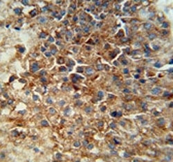CD46 antibody immunohistochemistry analysis in formalin fixed and paraffin embedded human hepatocarcinoma.