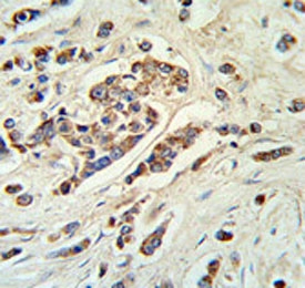ABCC11 antibody IHC analysis in formalin fixed and paraffin embedded breast carcinoma.~