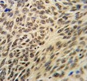 XRCC6 antibody IHC analysis in formalin fixed and paraffin embedded human lung carcinoma.