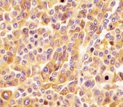 IHC testing of FFPE human melanoma tissue with CD63 antibody at 1:25 dilution. HIER: steam tissue sections in 10mM citrate buffer, pH 6, for 10-20 min followed by cooling at RT for 20 min.