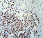 XRCC1 antibody immunohistochemistry analysis in formalin fixed and paraffin embedded human skin carcinoma.