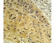 IHC staining of FFPE human lung carcinoma with WNT5A antibody. HIER: boil tissue sections in pH6, 10mM citrate buffer, for 20 min and allow to cool before testing.