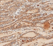 IHC staining of FFPE human thyroid carcinoma with WNT5A antibody. HIER: boil tissue sections in pH 9 EDTA for 20 min and allow to cool before testing.
