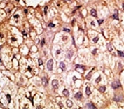 IHC analysis of FFPE human hepatocarcinoma tissue stained with the ACE2 antibody