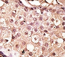 IHC analysis of FFPE human breast carcinoma tissue stained with the ACE2 antibody
