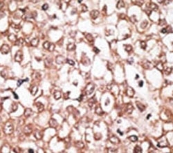 IHC analysis of FFPE human hepatocarcinoma tissue stained with the ABCB11 antibody~