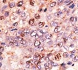 IHC analysis of FFPE human hepatocarcinoma tissue stained with the ABCB7 antibody~