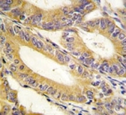 IHC analysis of FFPE human colon carcinoma tissue stained with XIAP antibody