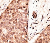 IHC analysis of FFPE human breast carcinoma tissue stained with the CDX2 antibody
