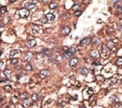 IHC analysis of FFPE human hepatocarcinoma tissue stained with the Leptin Receptor antibody