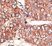 IHC analysis of FFPE human hepatocarcinoma tissue stained with the Megalin antibody