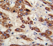 IHC analysis of FFPE human hepatocarcinoma stained with MMP3 antibody