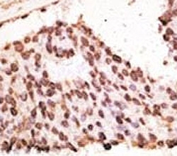 IHC analysis of FFPE human breast carcinoma tissue stained with the MMP7 antibody