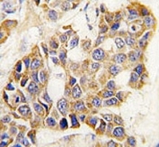 IHC analysis of FFPE human breast carcinoma tissue stained with MMP9 antibody