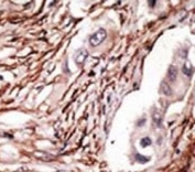 IHC analysis of FFPE human breast carcinoma tissue stained with the NOTCH3 antibody