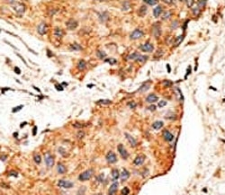 IHC analysis of FFPE human breast carcinoma tissue stained with the NRG1 antibody