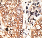 IHC analysis of FFPE human hepatocarcinoma tissue stained with the NRG2 antibody