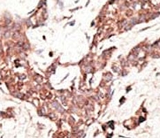 IHC analysis of FFPE human breast carcinoma tissue stained with the SIRT3 antibody