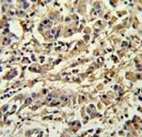SIRT3 antibody IHC analysis in formalin fixed and paraffin embedded human breast carcinoma.
