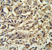 SIRT3 antibody IHC analysis in formalin fixed and paraffin embedded human breast carcinoma.