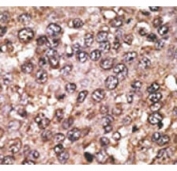 IHC analysis of FFPE human hepatocarcinoma tissue stained with the SIRT5 antibody