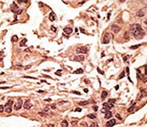 IHC analysis of FFPE human breast carcinoma tissue stained with the SIRT6 antibody