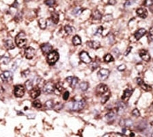 IHC analysis of FFPE human hepatocarcinoma tissue stained with the SIRT7 antibo