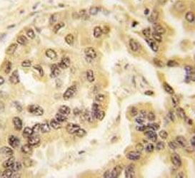 IHC analysis of FFPE human lung carcinoma tissue stained with p53 antibody